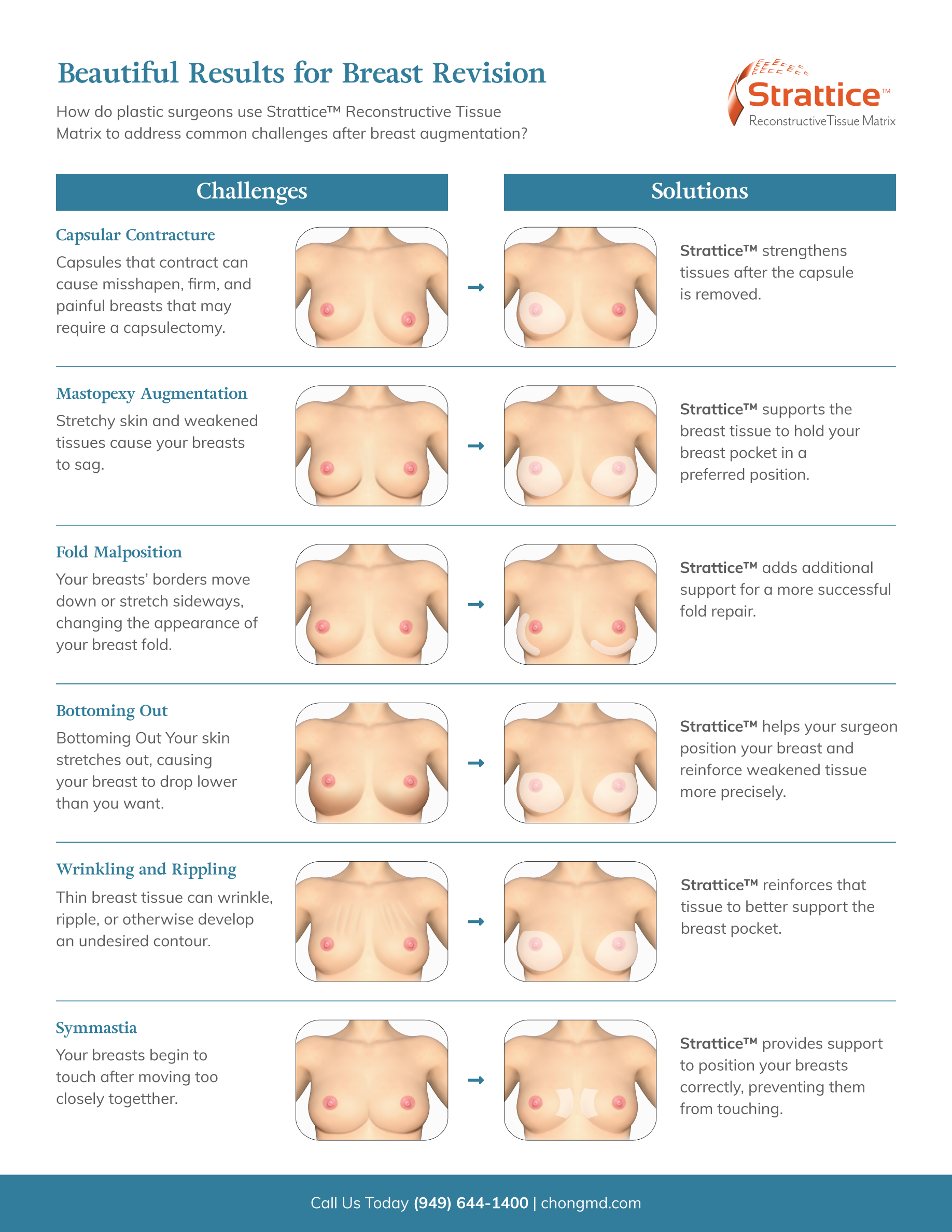 Internal Bra Procedure for Breast Implant Repair of Symmastia