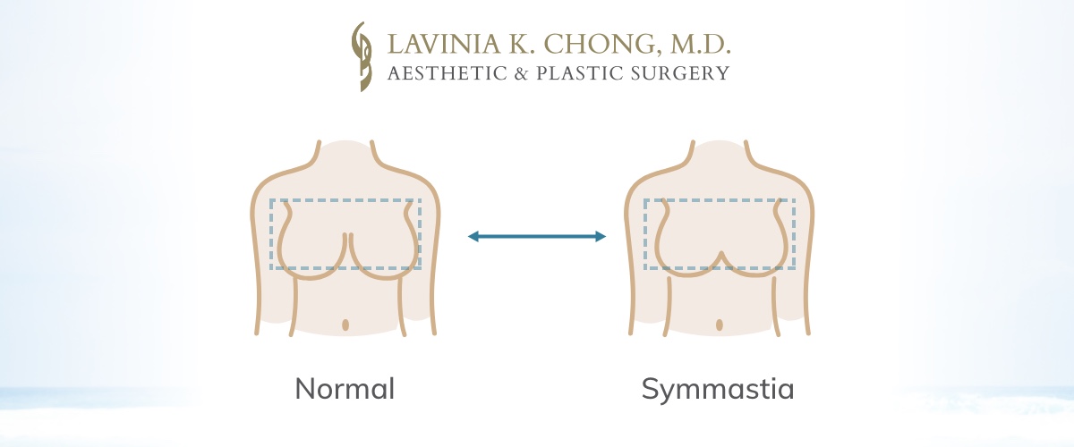 Symmastia breast implant displacement (uni-boob) problems