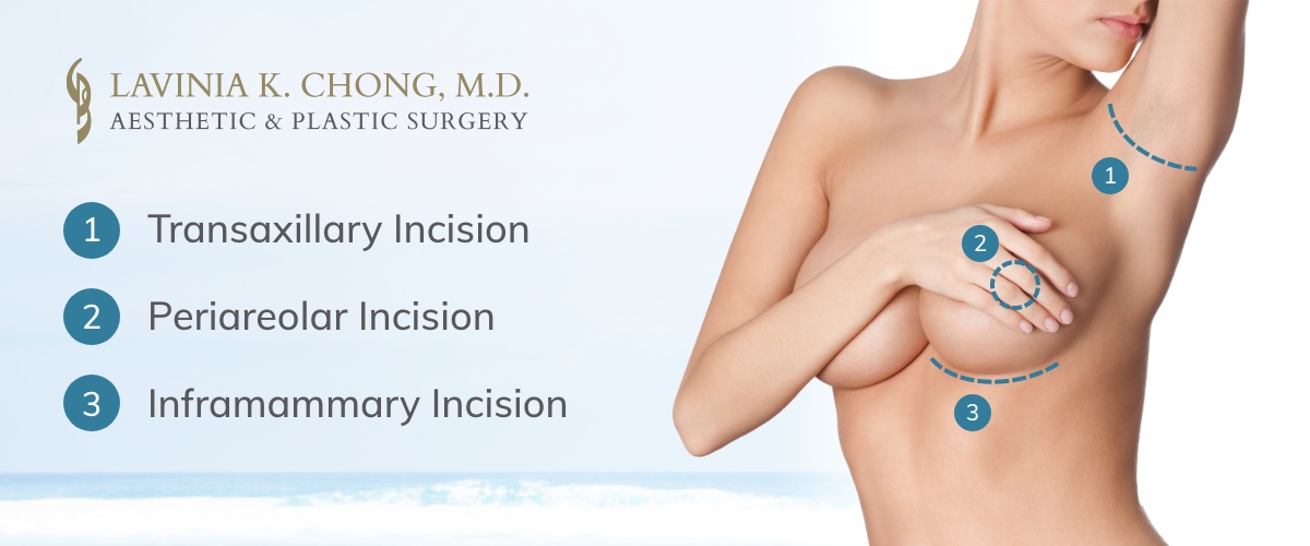 Breast Implant Animation Deformity: Causes & Treatment